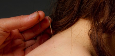 Acupuncture and cancer care burnsville